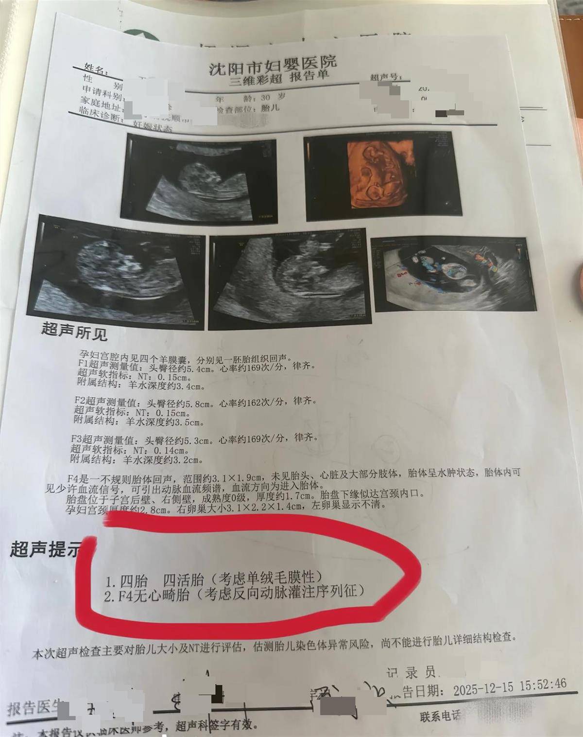 辽宁一孕妇两个月内从一胎变四胞胎，每次产检发现多出一胎，医生：系同卵四胞胎，概率1300万至1500万分之一